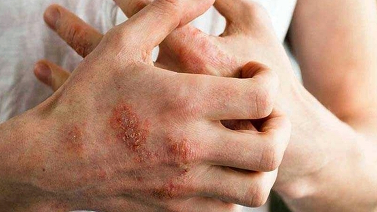 اگزما؛ بیماری شایع فصل پاییز