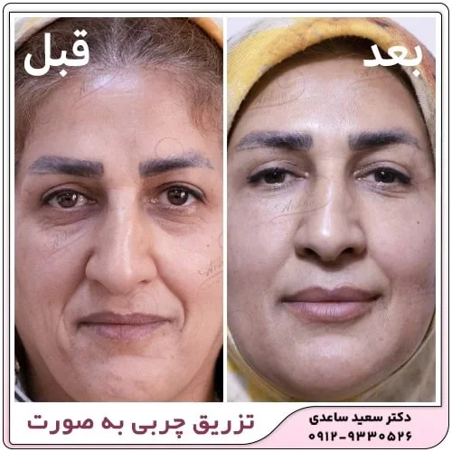دوره نقاهت تزریق چربی به صورت