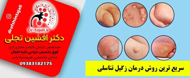دکتر تجلی فوق تخصص درمان زگیل تناسلی اصفهان|کلینیک ارولوژی